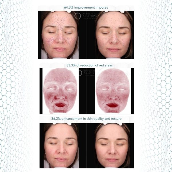 GF5 Case study GF5 Next Generation case study redness pores texture