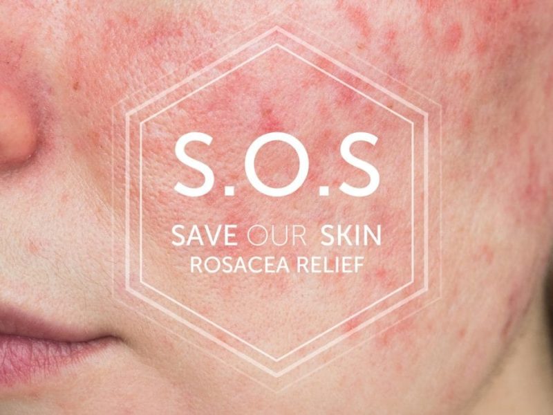 Rosacea skin save our skin