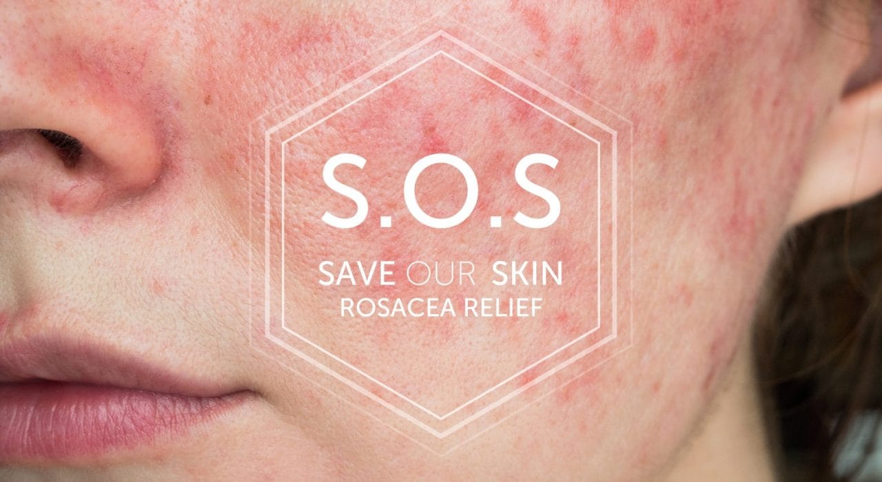 Rosacea skin save our skin