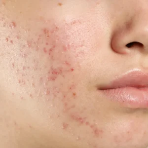 Close-up of acne-prone skin for CellDerma skin concern category
