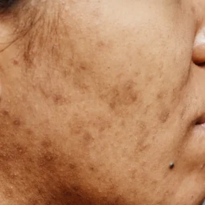Close-up of pigmentation for CellDerma skin concern category