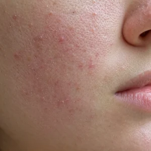 Close-up of dry skin for CellDerma skin concern category