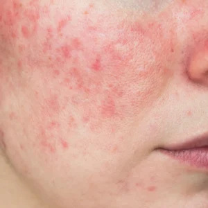 Close-up of facial redness and rosacea