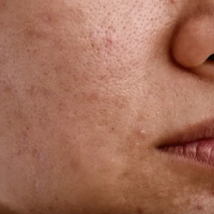 Close-up of sensitive skin for CellDerma skin concern category