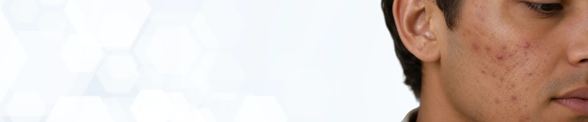 Acne-Hero-Banner-