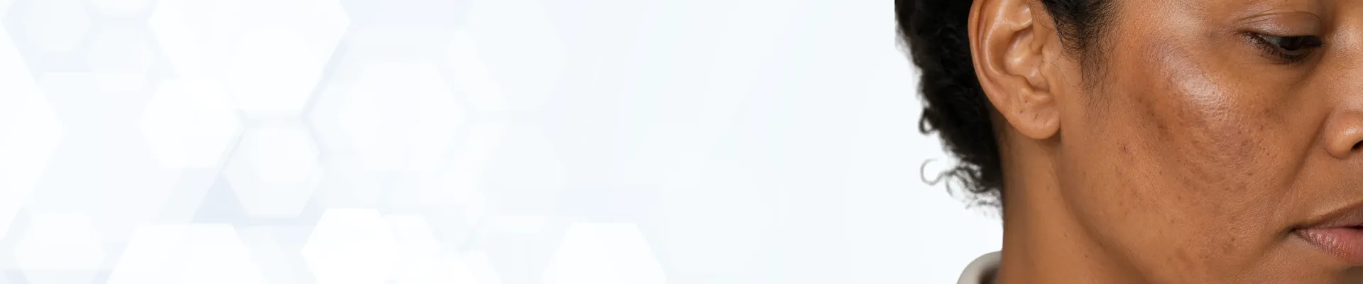 Pigmentation-Hero-Banner-
