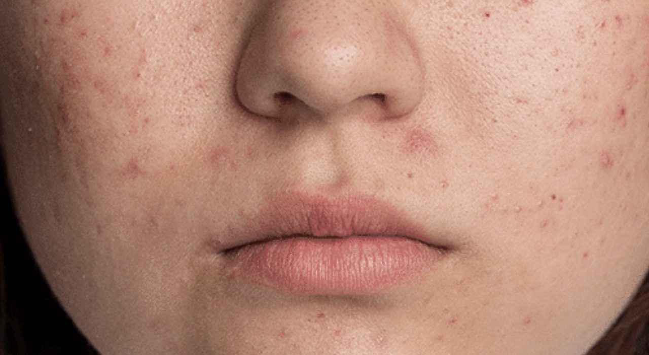 lower face of model lady with acne