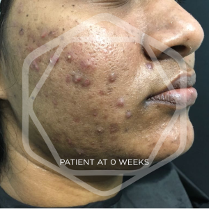 A woman with severe acne before using CellDerma Retin-ACE