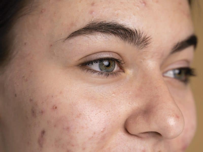 A teenage girl with acne on her cheeks