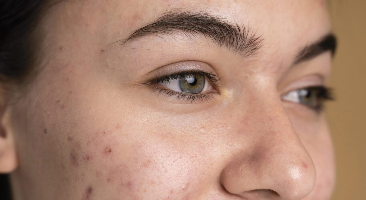 A teenage girl with acne on her cheeks