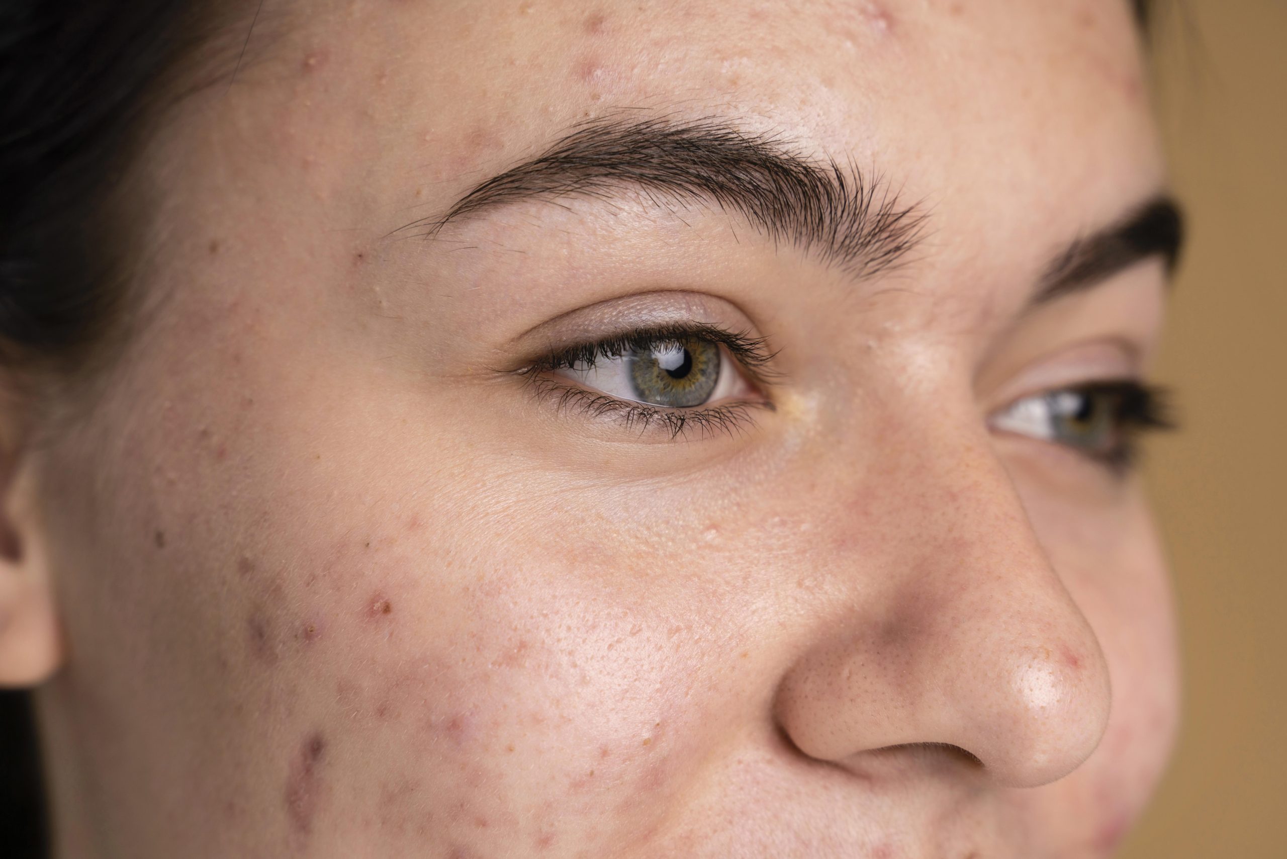 A teenage girl with acne on her cheeks