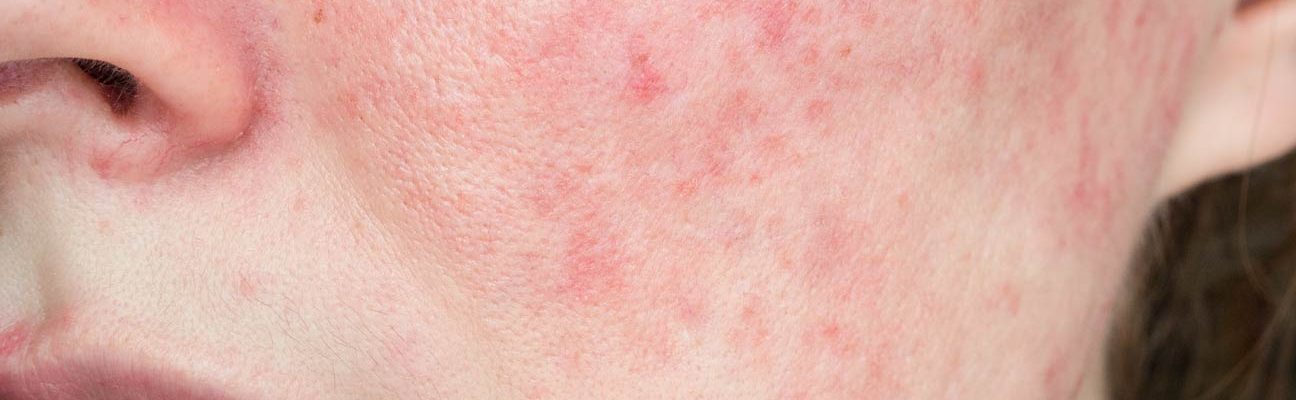 Rosacea on cheeks
