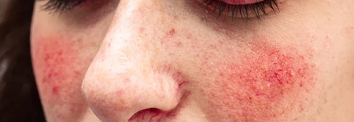 a woman with rosacea on her cheeks