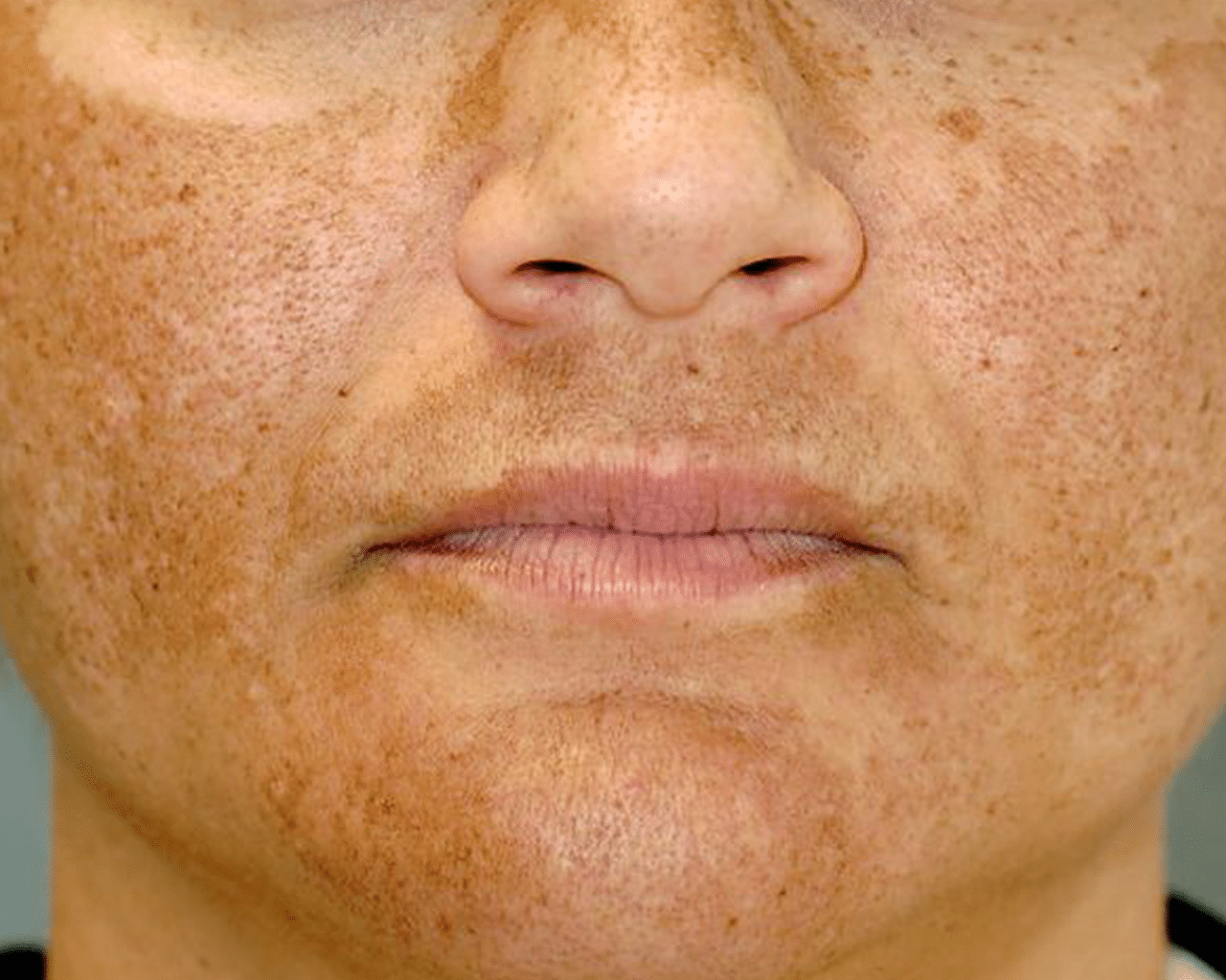 CellDerma Melasma Face Close Up Close Up Content Image