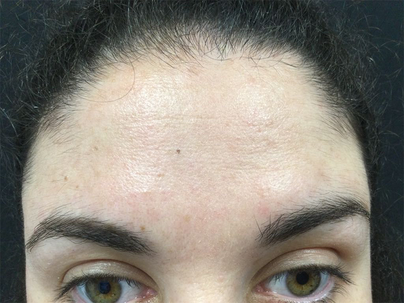 Female forehead without pigmentation or discolouration