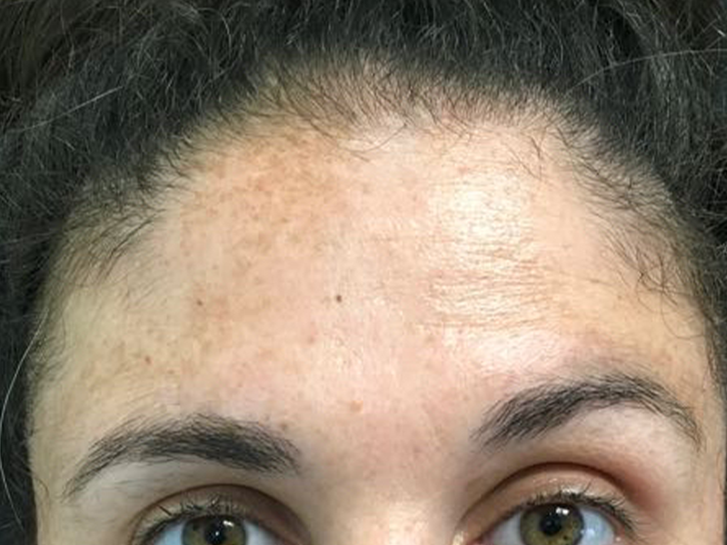 Female forehead with heavy discolouration and pigmentation