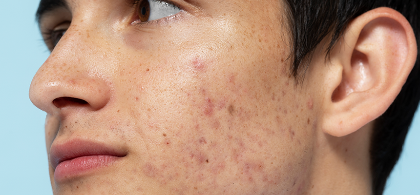 A young male with moderate acne on his left cheek