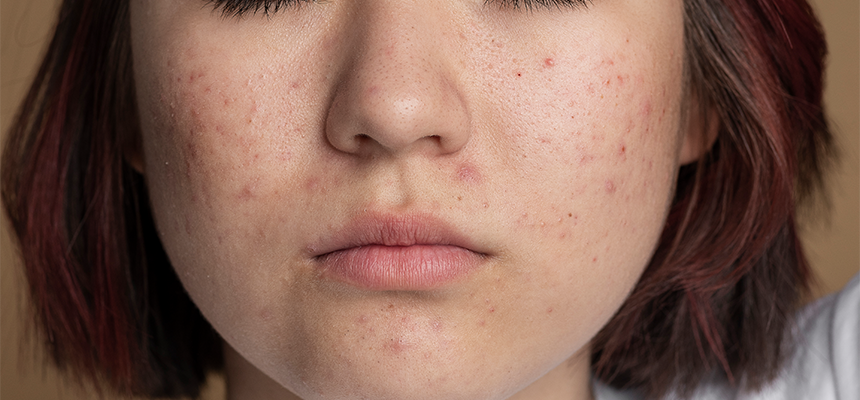 A young female with congested skin and mild acne