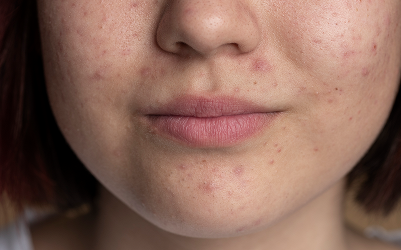 A cropped photograph showing a young female's chin, cheeks and lips. She has mild acne but is softly smiling