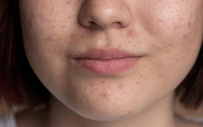 A cropped photograph showing a young female's chin, cheeks and lips. She has mild acne but is softly smiling