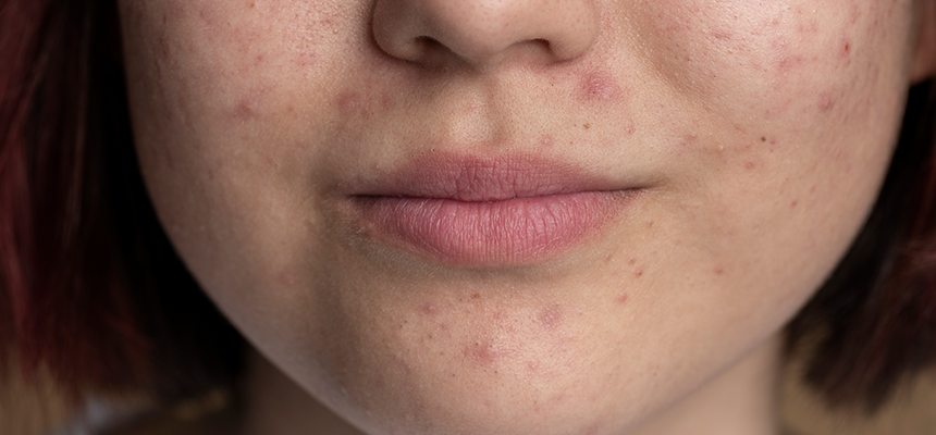 A cropped photograph showing a young female's chin, cheeks and lips. She has mild acne but is softly smiling