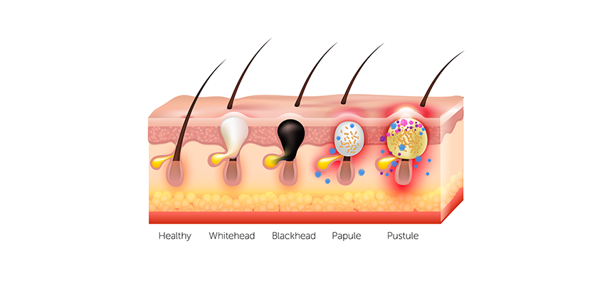 Illustrated scientific diagram of the skin layers, showing 5 different types of acne. Shows a healthy hair follicle, a whitehead, a blackhead, a papule and a pustule.