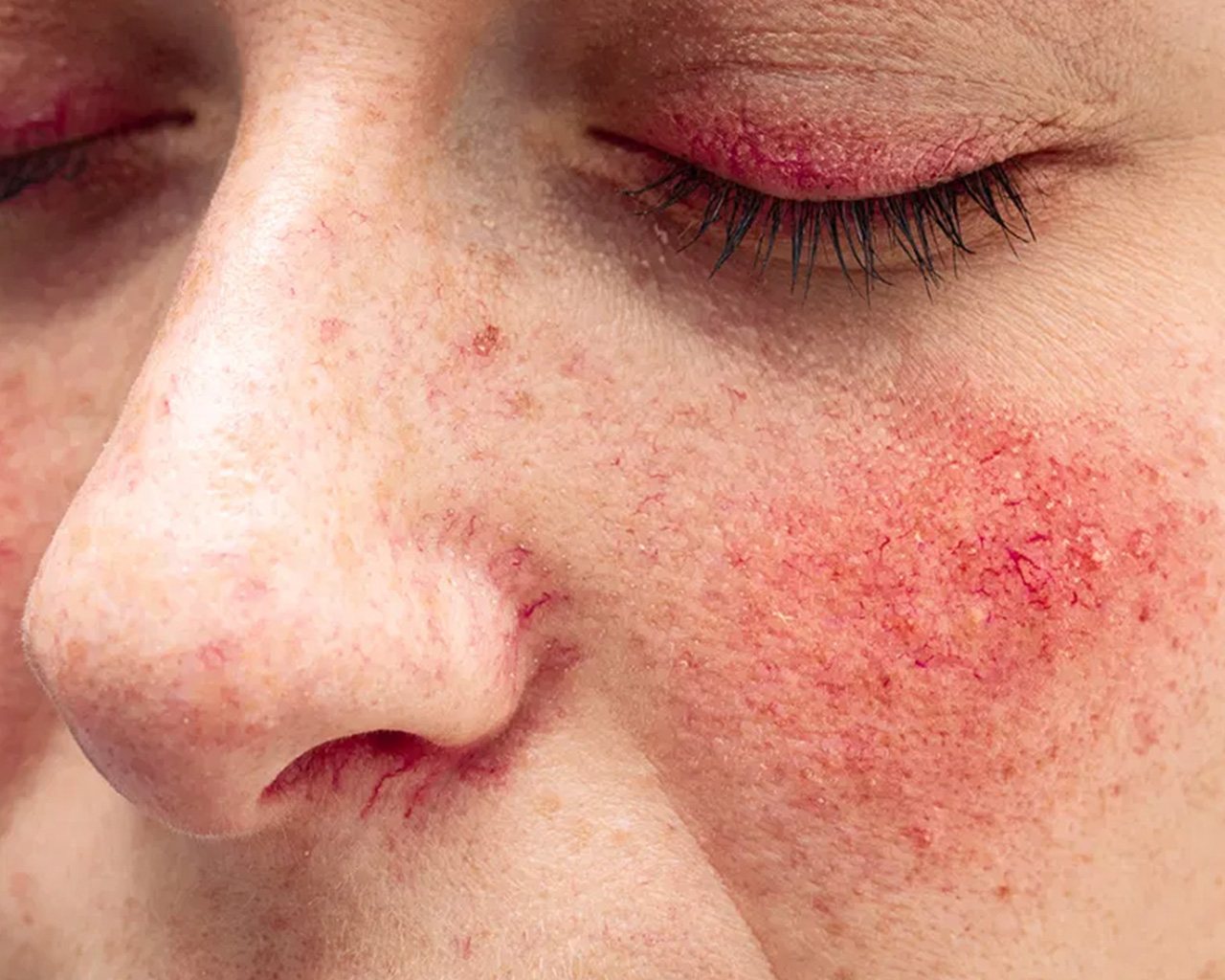 A close up of rosacea on a female cheek