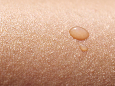 Droplet on skin