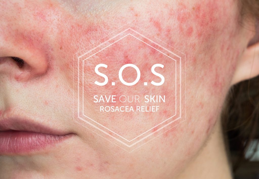 rosacea skin sos