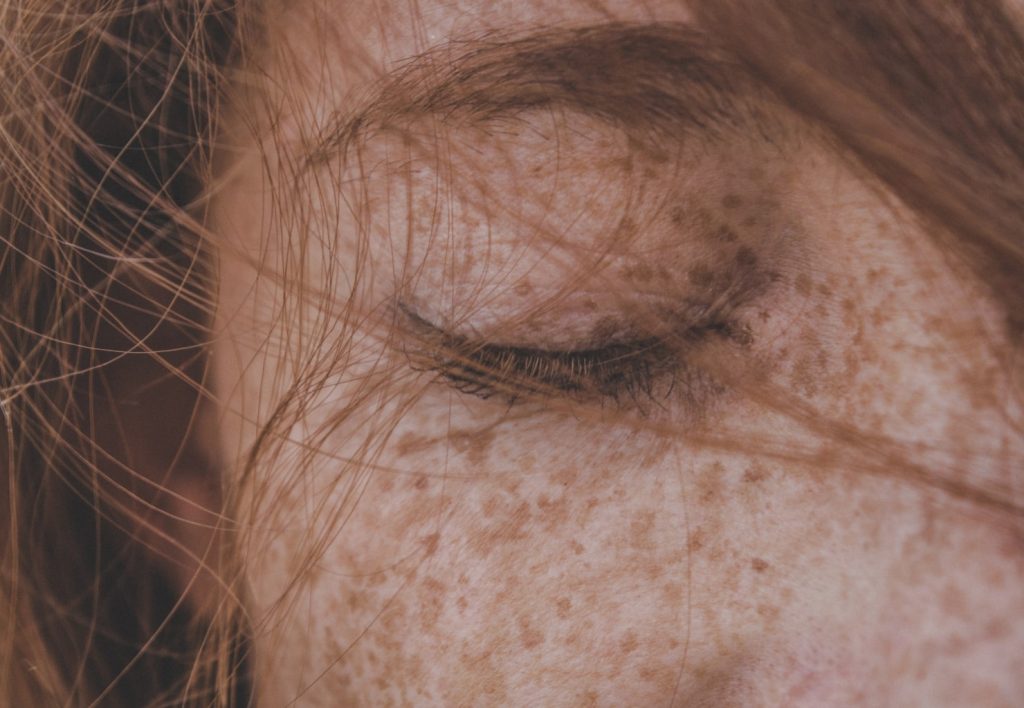 pigmentation freckles on face
