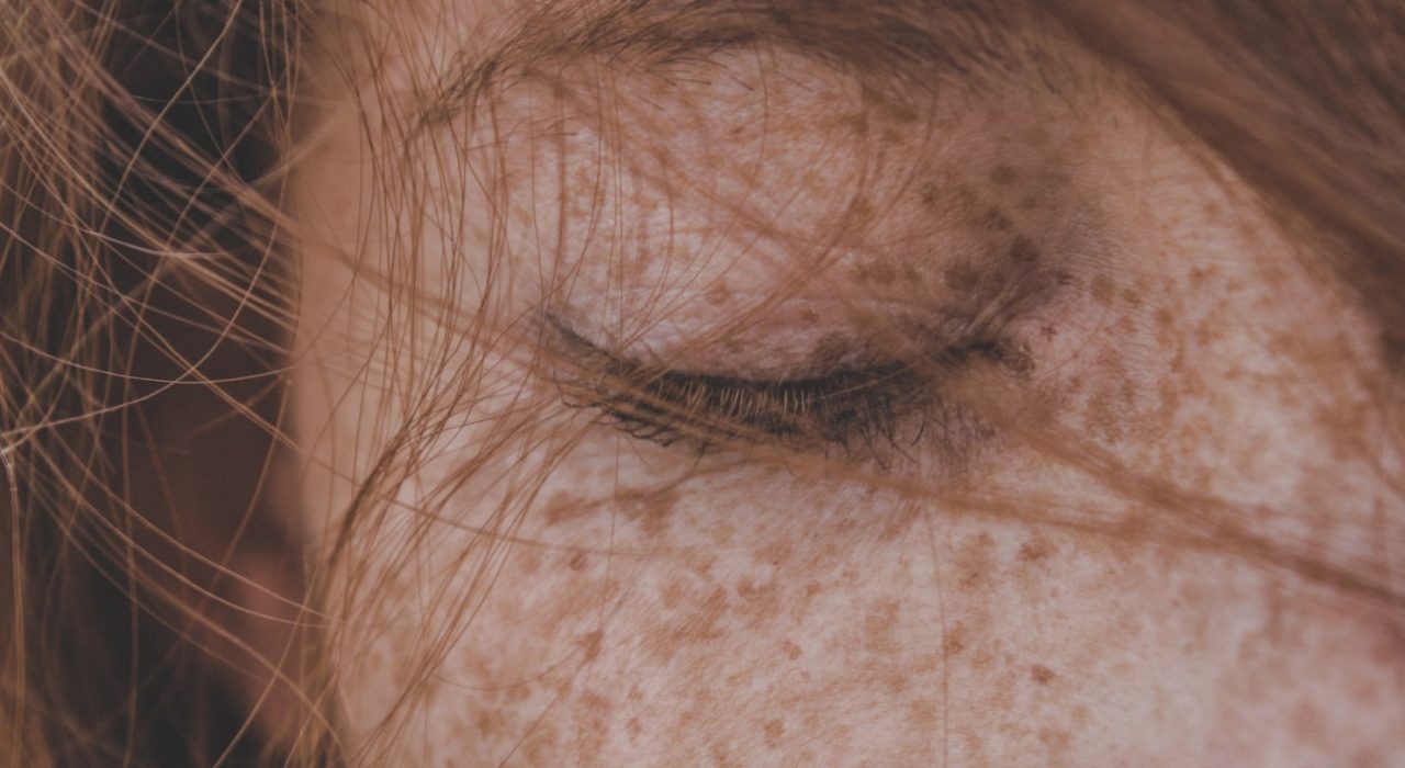 pigmentation freckles on face