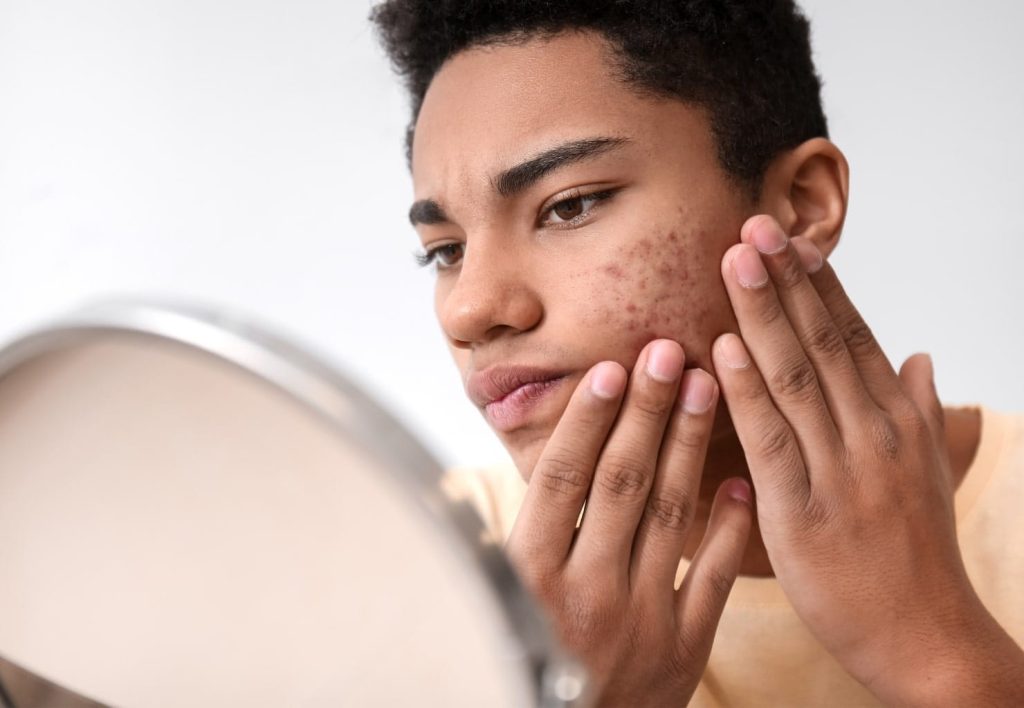 man cheek acne
