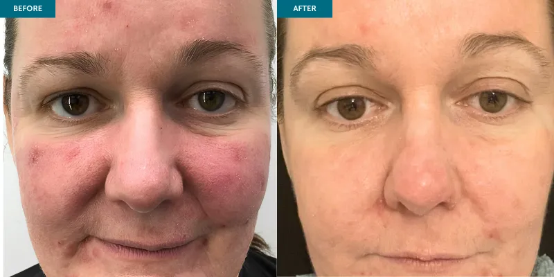 RETINACE (1)
