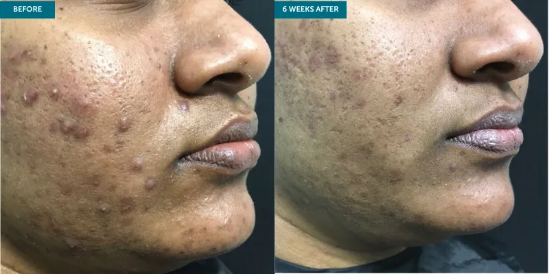 RETINACE +Hydraclean
