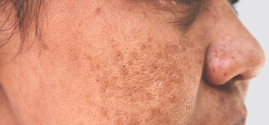 CellDerma Cheek Close Up Skin Pigmentation Content Image