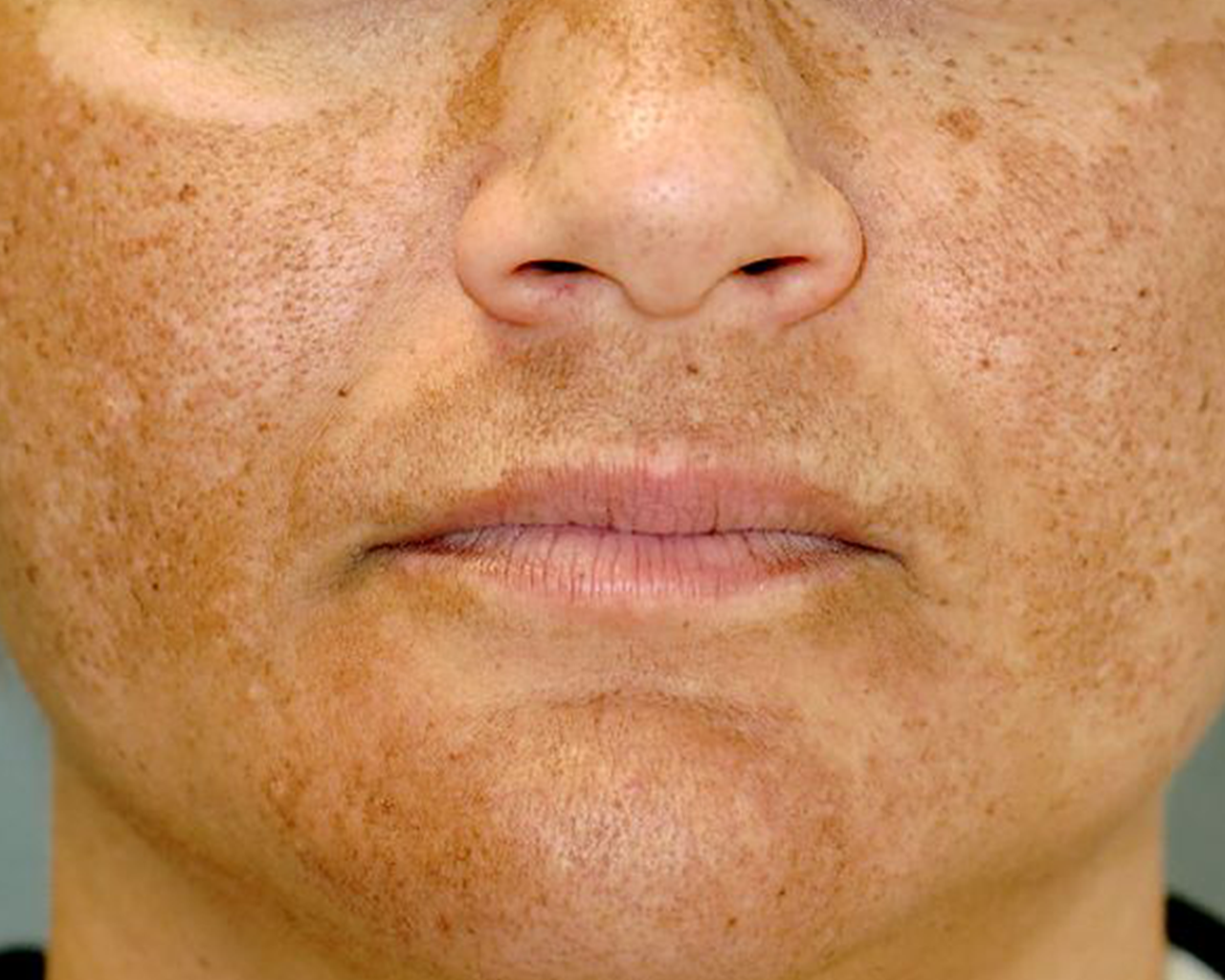 CellDerma Melasma Face Close Up Close Up Content Image