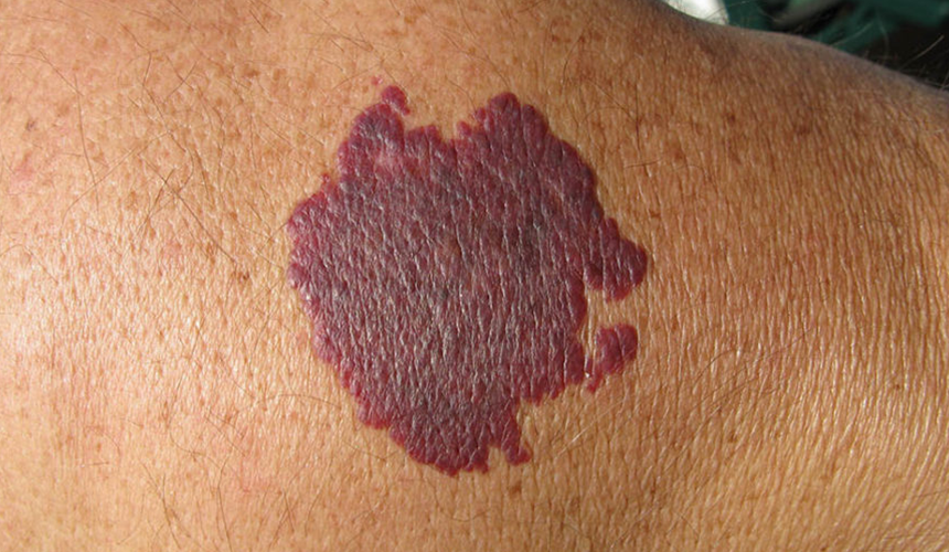 CellDerma Port Wine Stain Close Up Content Image