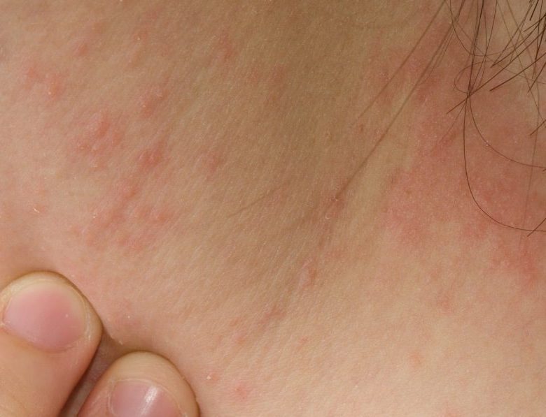 CellDerma Eczema Skin Close Up Content Image